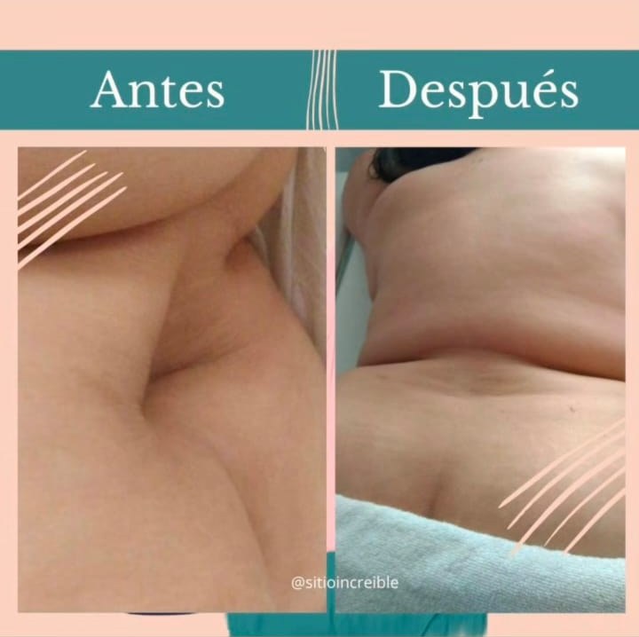 Antes y después real de espalda con maderoterapia y radiofrecuencia en el gabinete de Isabel