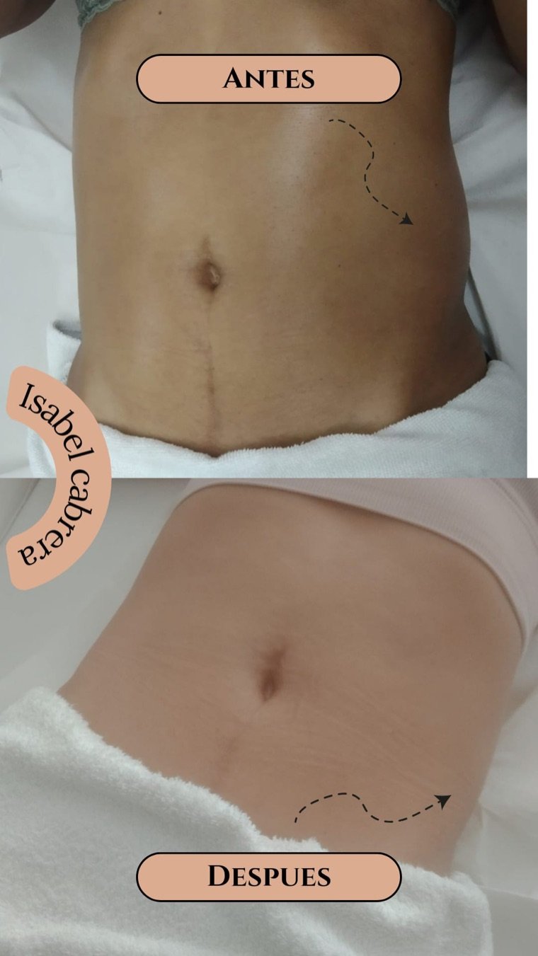 Antes y después real de una clienta tras 5 sesiones de maderoterapia y drenaje reductor con Isabel